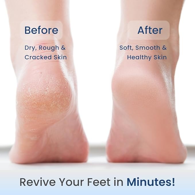 Medtech Revive Rechargeable Callus Remover for Feet | Foot scrubber for dead skin | 3 Roller Heads for Dead Skin Removal | Pedicure Machine